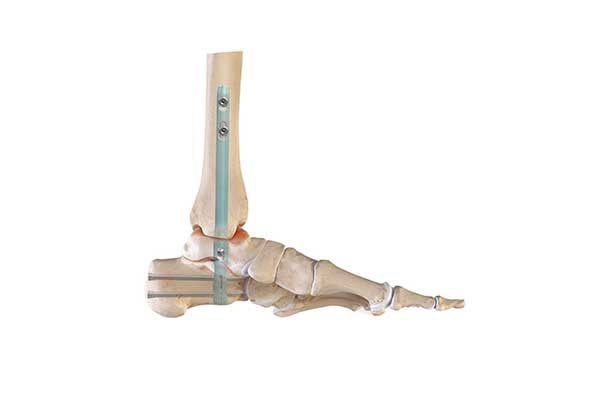 DualCompression Hindfoot Nail