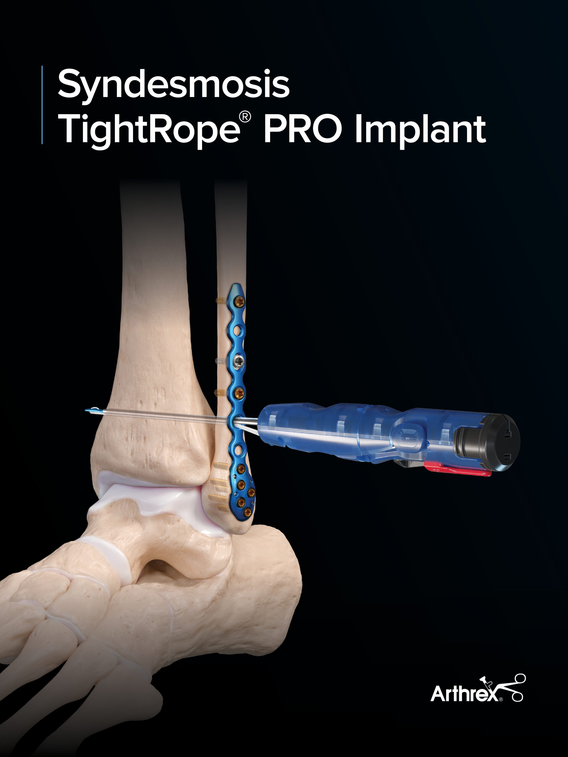 TightRope® PRO
